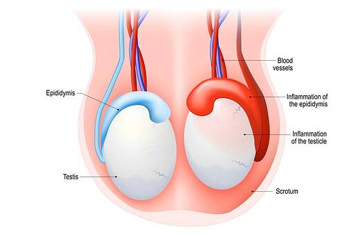 Epididymitis